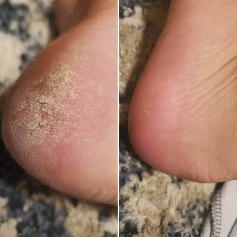 Exfoliador Nura Pro™