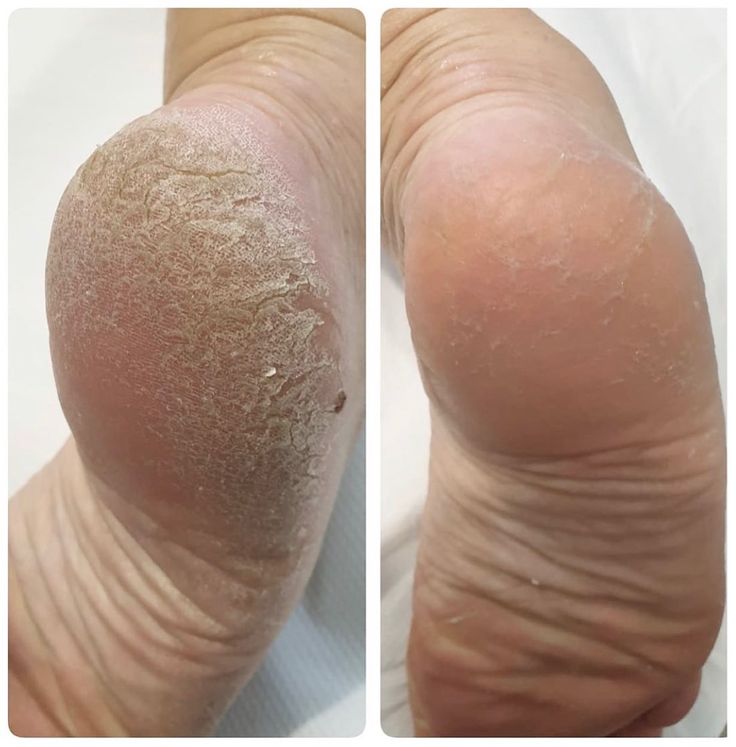 Exfoliador Nura Pro™