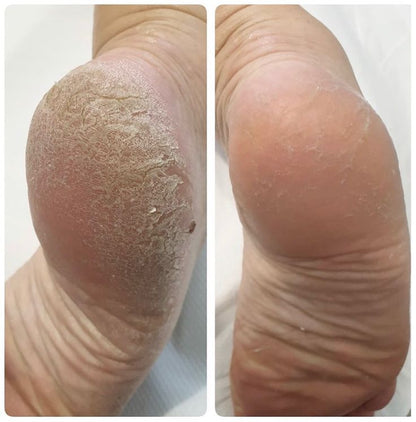 Exfoliador Nura Pro™